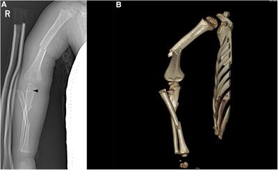 Case report: Pediatric floating elbow fracture with monteggia-equivalent lesion, ipsilateral humeral shaft fracture, and radial nerve injury: a unique case and favorable treatment outcomes